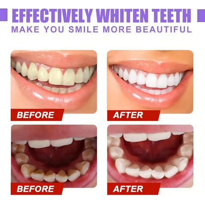 Kit de blanqueo dental profesional 3 en 1