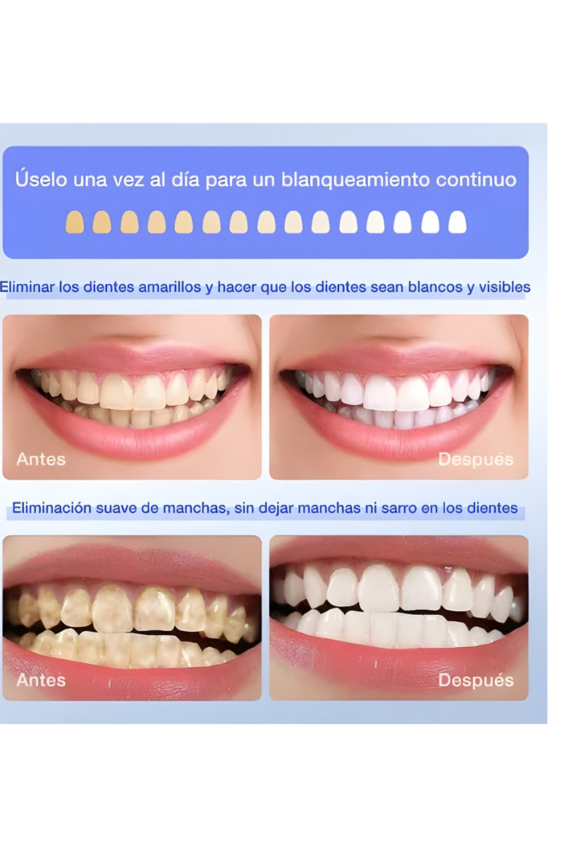 Kit de blanqueo dental profesional 3 en 1