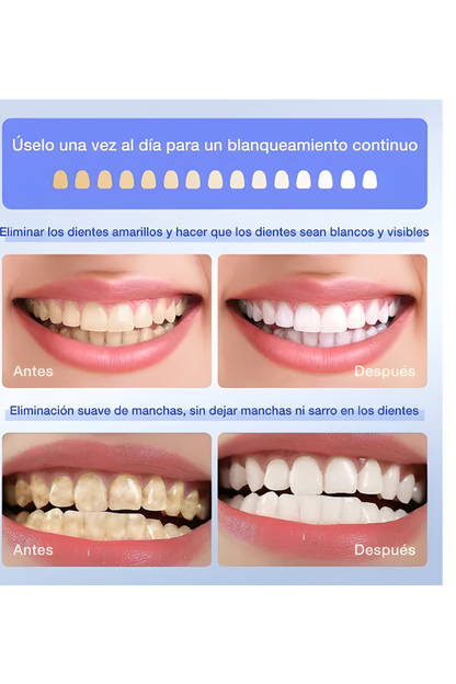 Kit de blanqueo dental profesional 3 en 1